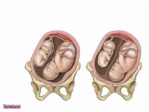 نشانه ها و علائم اولیه بارداری دوقلو